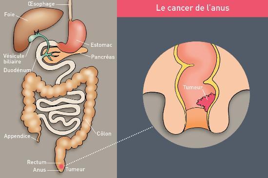 Cancer de l'anus : je m'informe - Dr. Peter Van De Walle ...